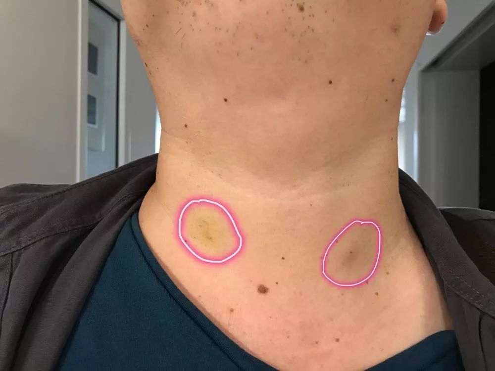 看到这个彩超结果,根据甲状腺结节的诊治指南以及多年来的临床经验