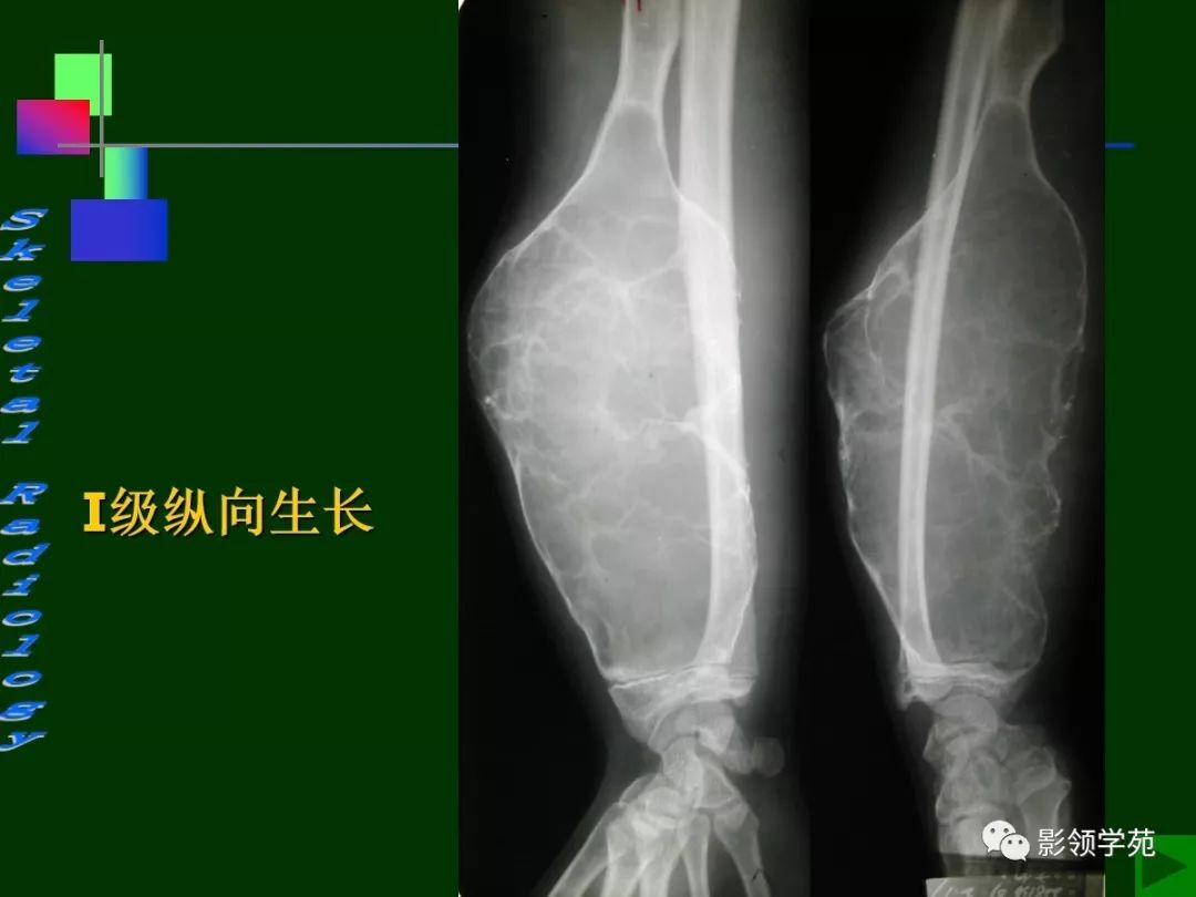 5cm颅骨骨瘤(文中所有图片点开可放大)
