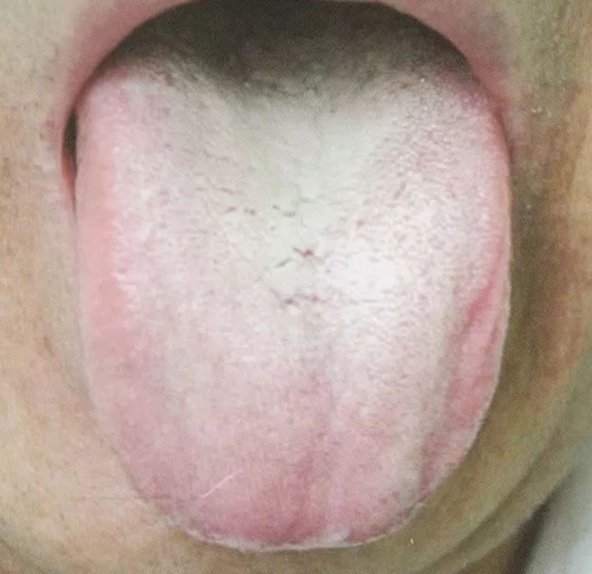 【艾学习】舌诊 │ 苔色_舌苔