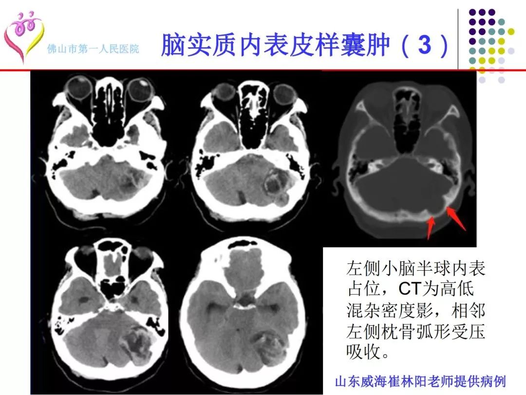 表皮囊肿黑色图片