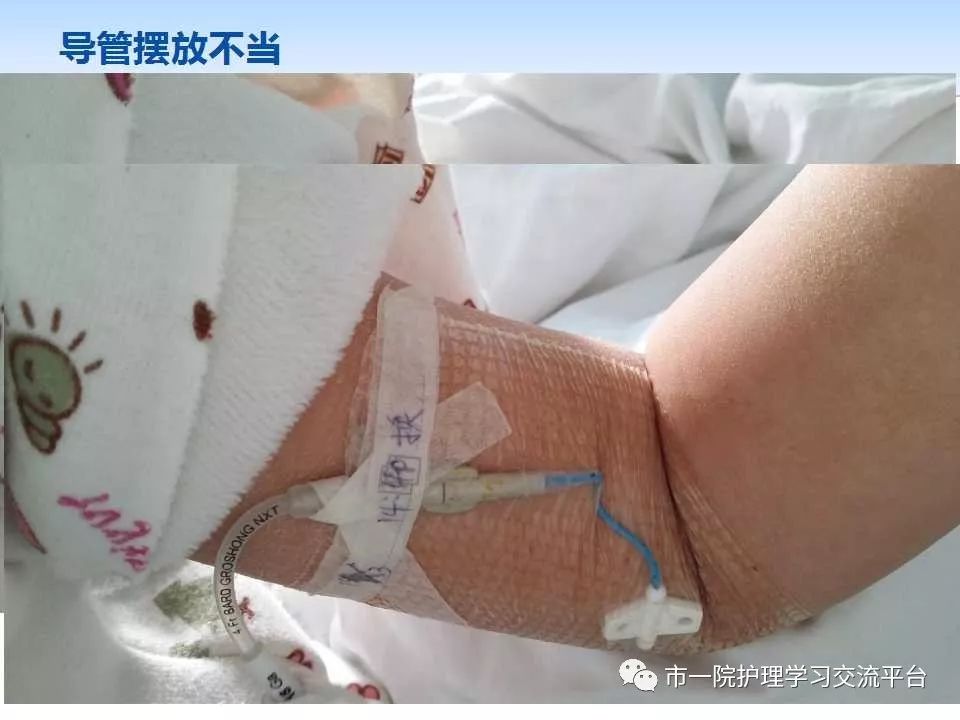 pptpicc导管规范化维护