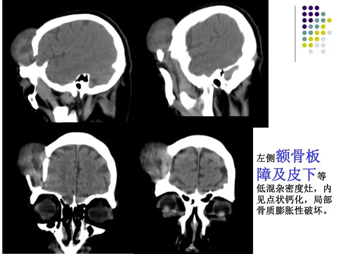 颅骨囊肿图片