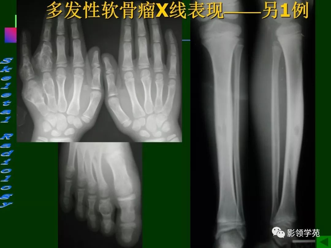 良性骨肿瘤影像诊断