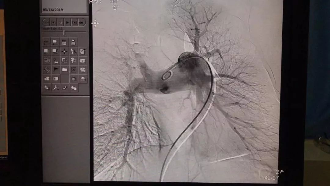 【新闻快递】呼吸与危重症医学科二病区独立开展右心导管术