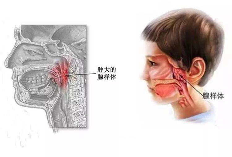 孩子扁桃體反覆發炎?注意力不集中?睡覺打鼾?根源可能在這!