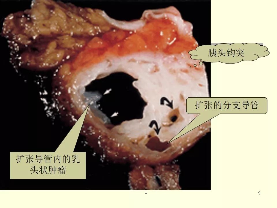 乳管内乳头状瘤早期图片