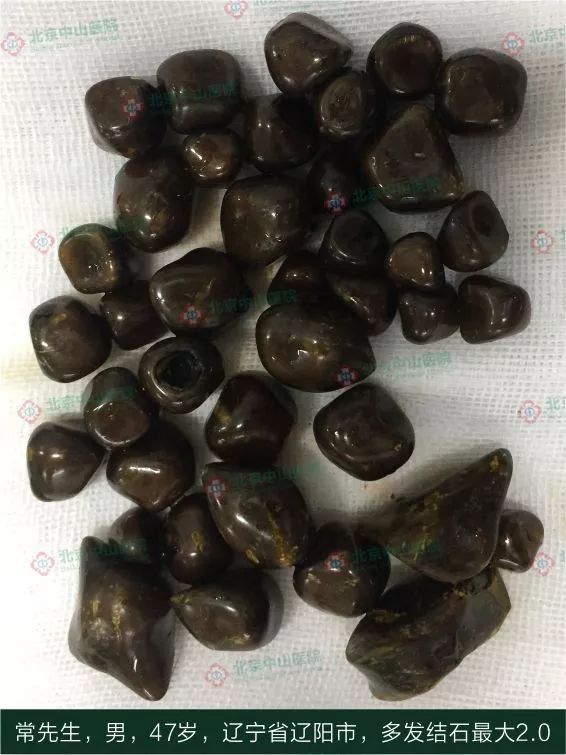 北京中山医院保胆取石手术实录一张保胆的希望车票与545颗胆囊结石