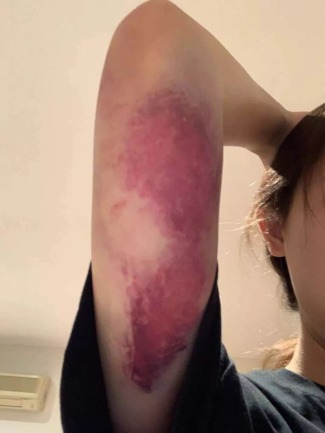 她的身上经常出现多处淤青,这些伤痕也会在不经意间被其他朋友看到.