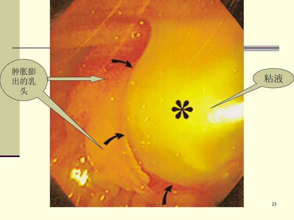 胰腺导管内乳头状黏液瘤