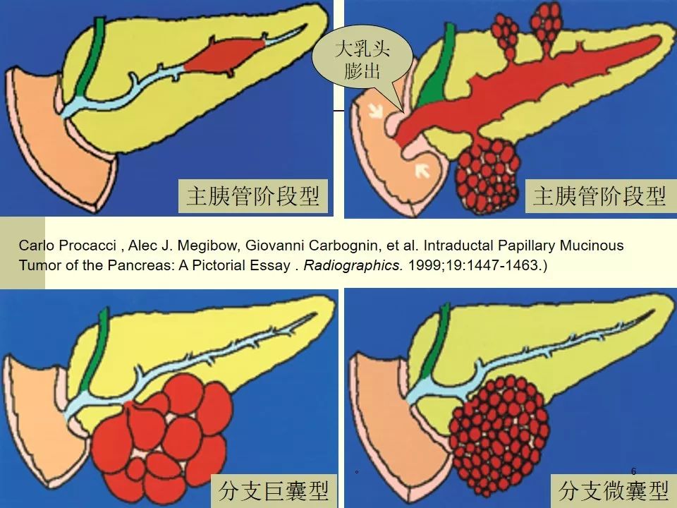 什么是胰腺导管内乳头状黏液性肿瘤？