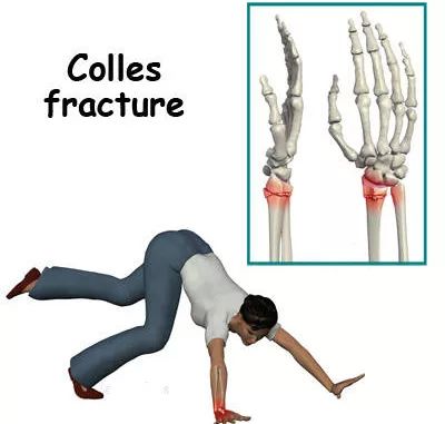 冬季安全记心间,远离"克雷氏骨折"_治疗