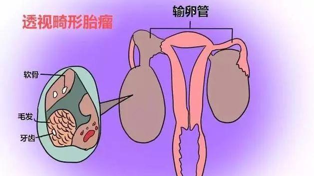 金华一7岁女孩得了卵巢畸胎瘤现孩子已顺利康复出院