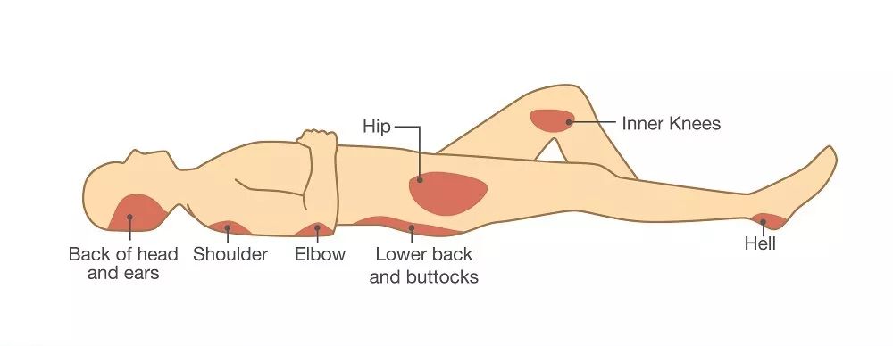 压力性损伤管理