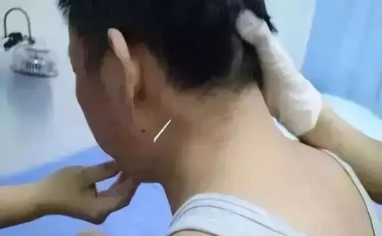 醒脑开窍针刺法的组成与操作最全收藏