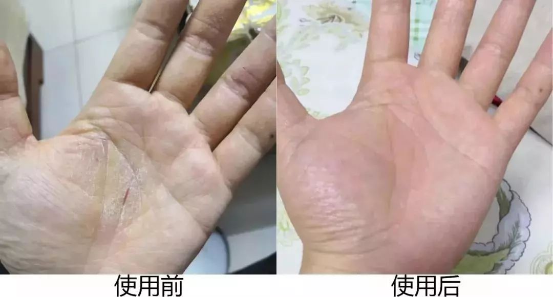 日本变态鳄鱼霜使用效果堪比换皮生物提取鳄鱼油用它干裂脱皮冻疮都能