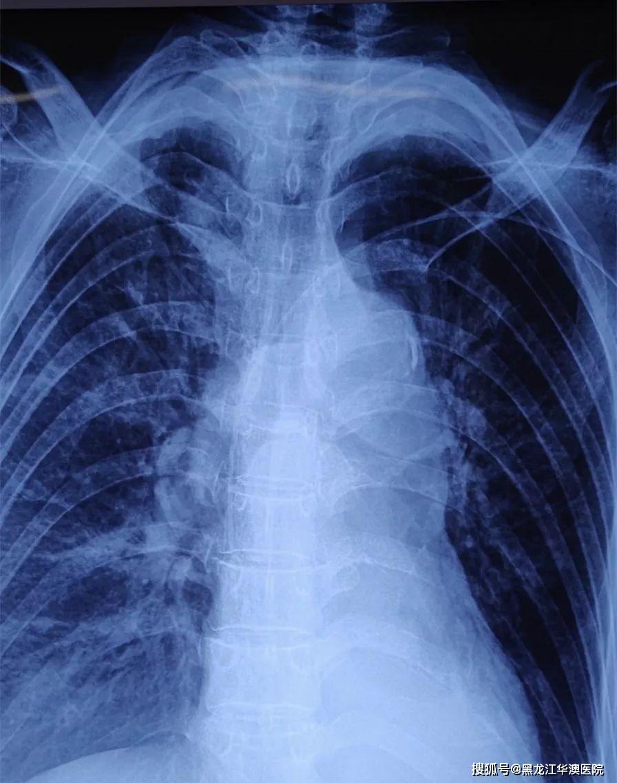 picc置管:一条安全有效的生命通道,为患者减少治疗痛苦