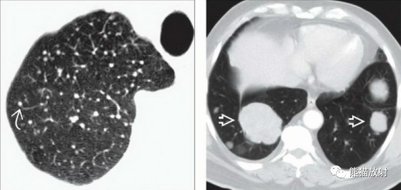 肺转移多种多样丨ct表现诊断要点