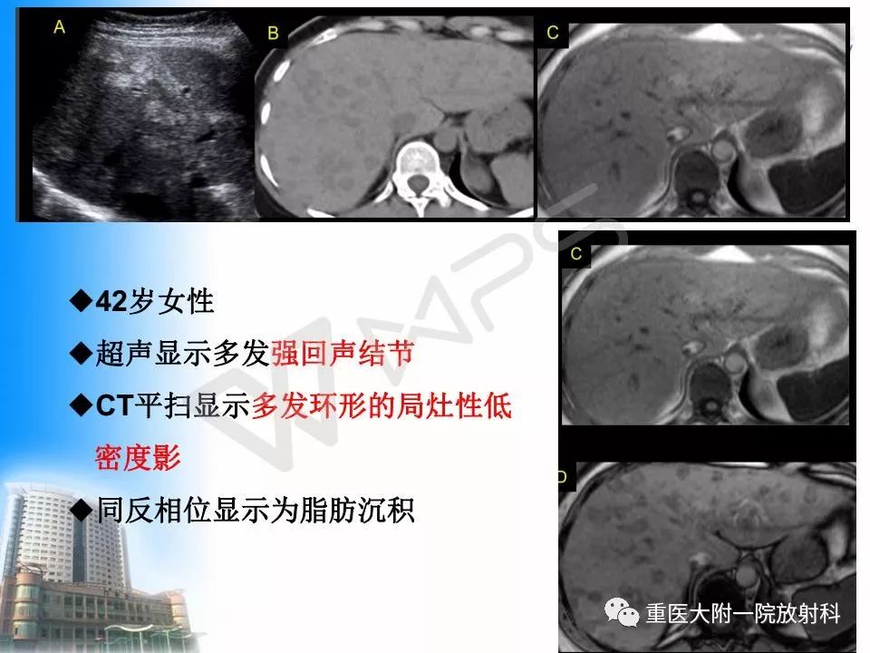 脂肪肝声像图改变图片