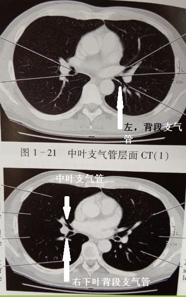 背段支气管阻塞极易漏诊这样看ct可以避免