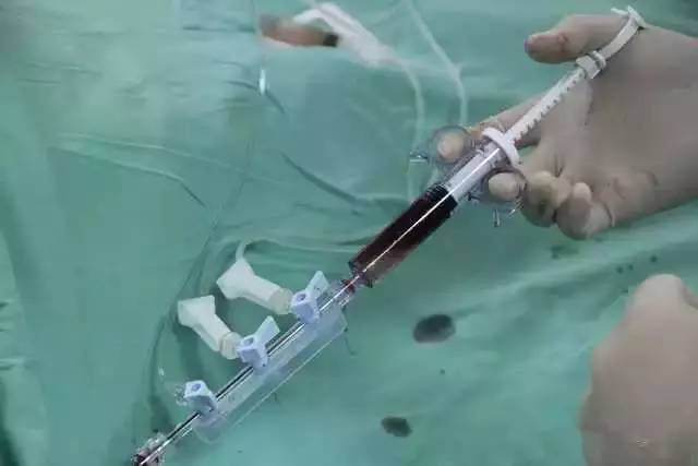 图片直播带你亲临冠脉支架介入手术现场