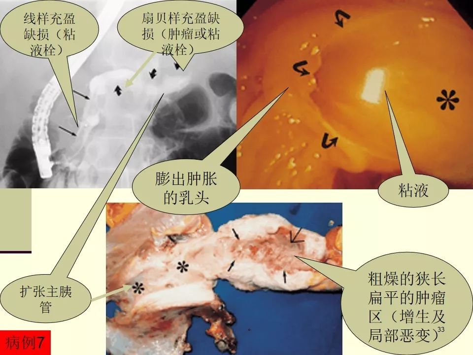 粘液乳头状型室管膜瘤图片