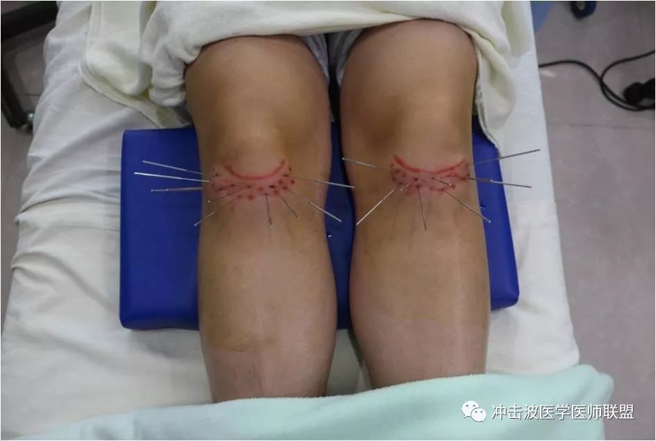 内热针治疗前交叉韧带重建术后功能障碍_膝关节