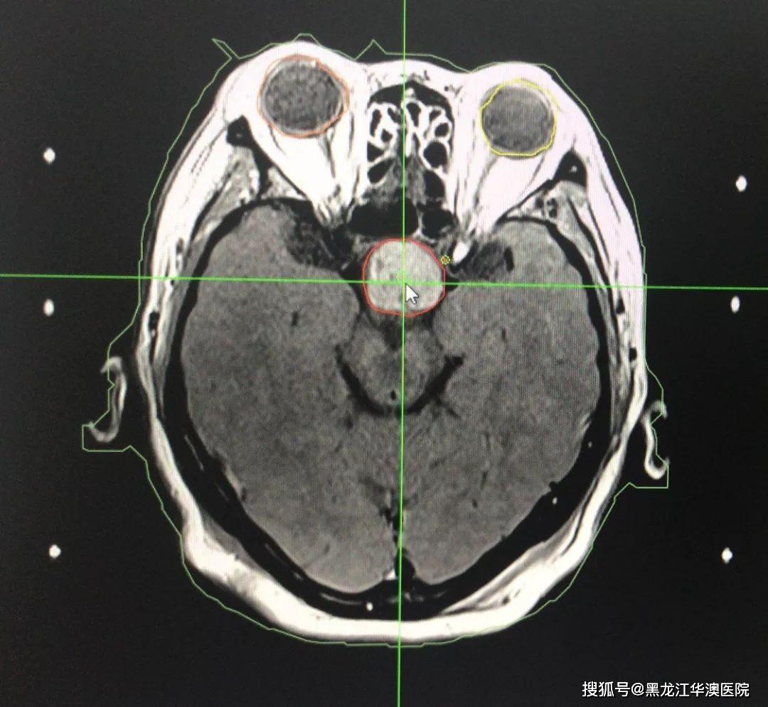 母亲患头部垂体瘤,求医四年,听视力严重受损,儿子奔赴750公里寻找新生