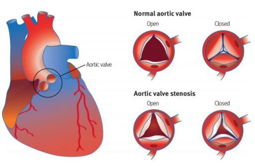 心脏瓣膜病就是指二尖瓣,三尖瓣,主动脉瓣和肺动脉瓣的瓣膜因风湿热