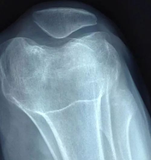 作为常规,主要是膝关节正,侧,轴位 x 线片,多伴有髌骨外移并倾斜,外侧