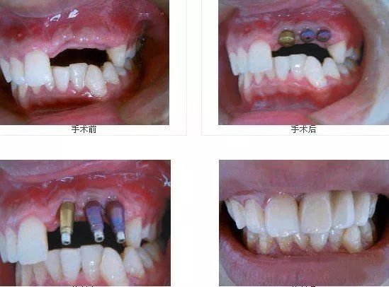 以微小創口植入,只需植入4-6顆種植體即可恢復半/全口牙齒缺失,並且無
