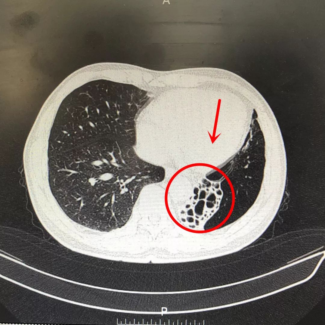 关注前沿反复咳痰究竟为那般三招助患者轻松排痰