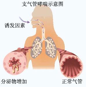 難纏的支氣管哮喘我們應該拿它怎麼辦