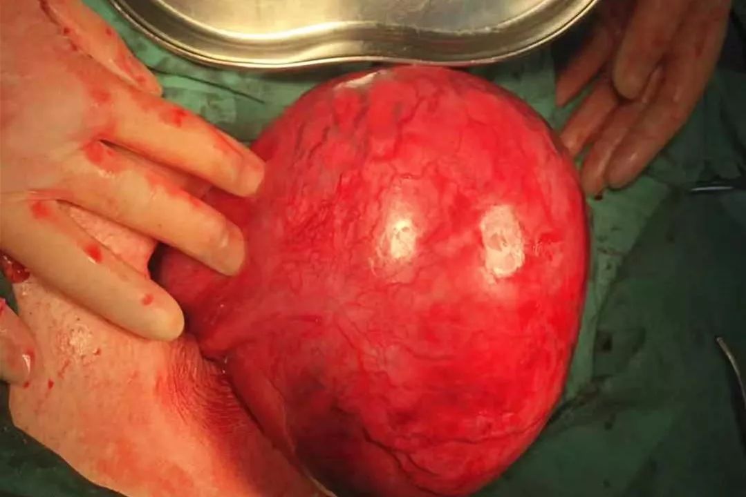 聚焦我院妇产科成功切除盆腔巨大包块1例