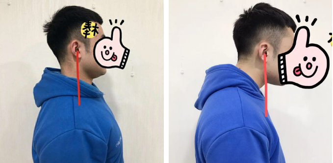 探颈--过两耳垂向下的垂线在肩膀前部; 圆肩--肩胛骨外展和上提 肱骨