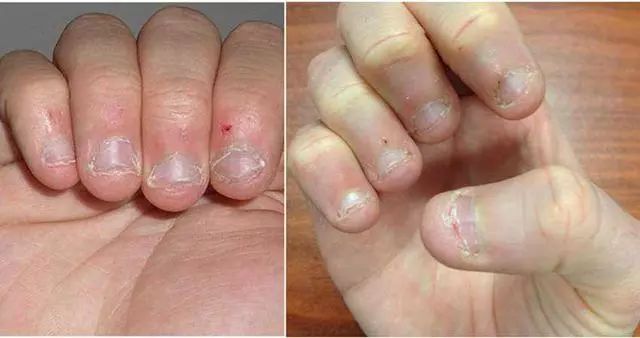 小时候爱咬指甲的娃10年后啥模样背后的2种原因引深思