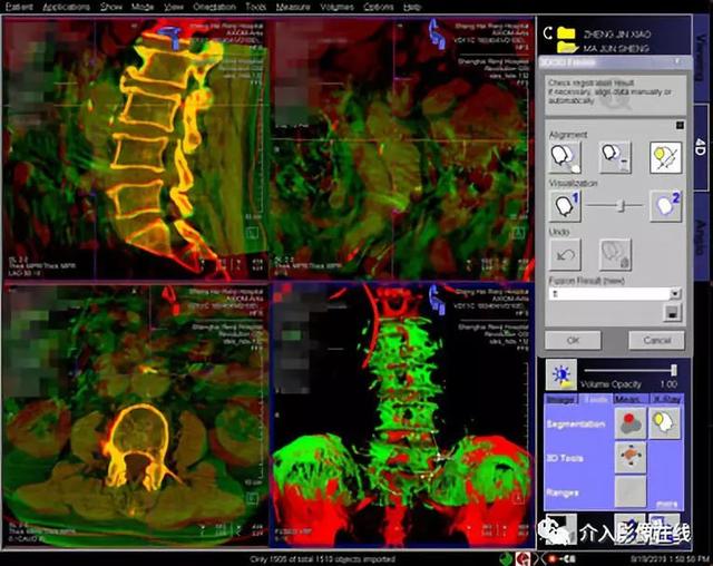 影像融合导航下的零造影剂腹主动脉夹层动脉瘤腔内隔绝术(evar)