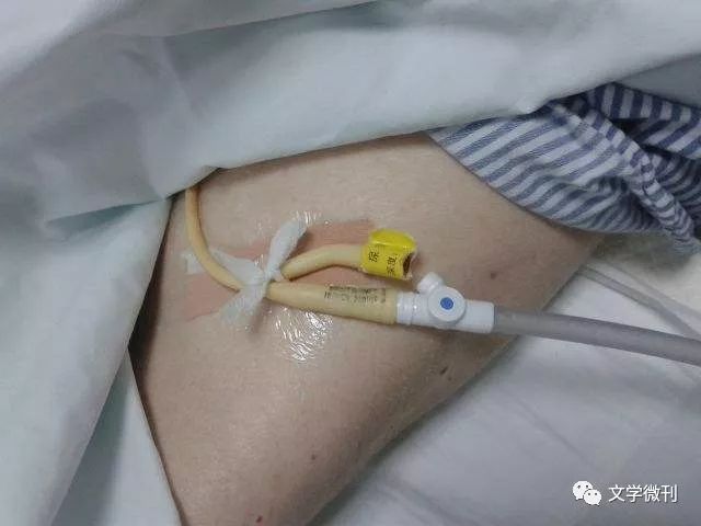 周二作家专栏赵国卿67小小导尿管