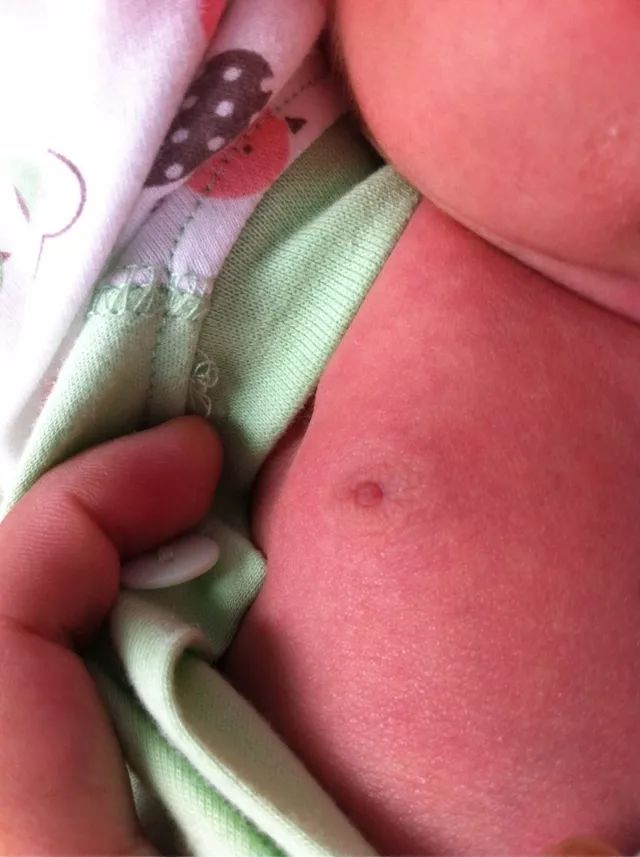1岁女婴胸部发育如核桃大小,不是性早熟真实原因竟是这个!_索票