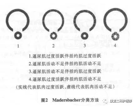 扳机点排尿法图片