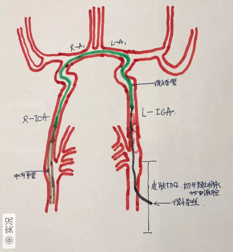 颈内动脉虹吸段示意图图片