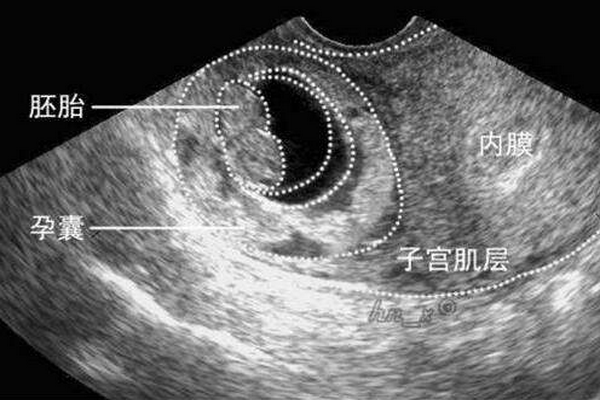 三个月的胎儿孕囊大小正常的是多大