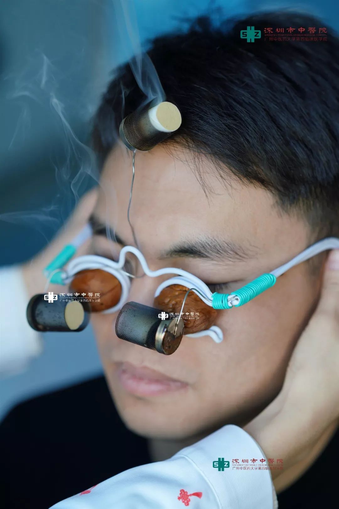 为患者们解决各种眼部疾病使用核桃壳做核桃灸深圳市中医院针灸二病区