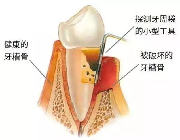 牙槽骨流失的原因有哪些