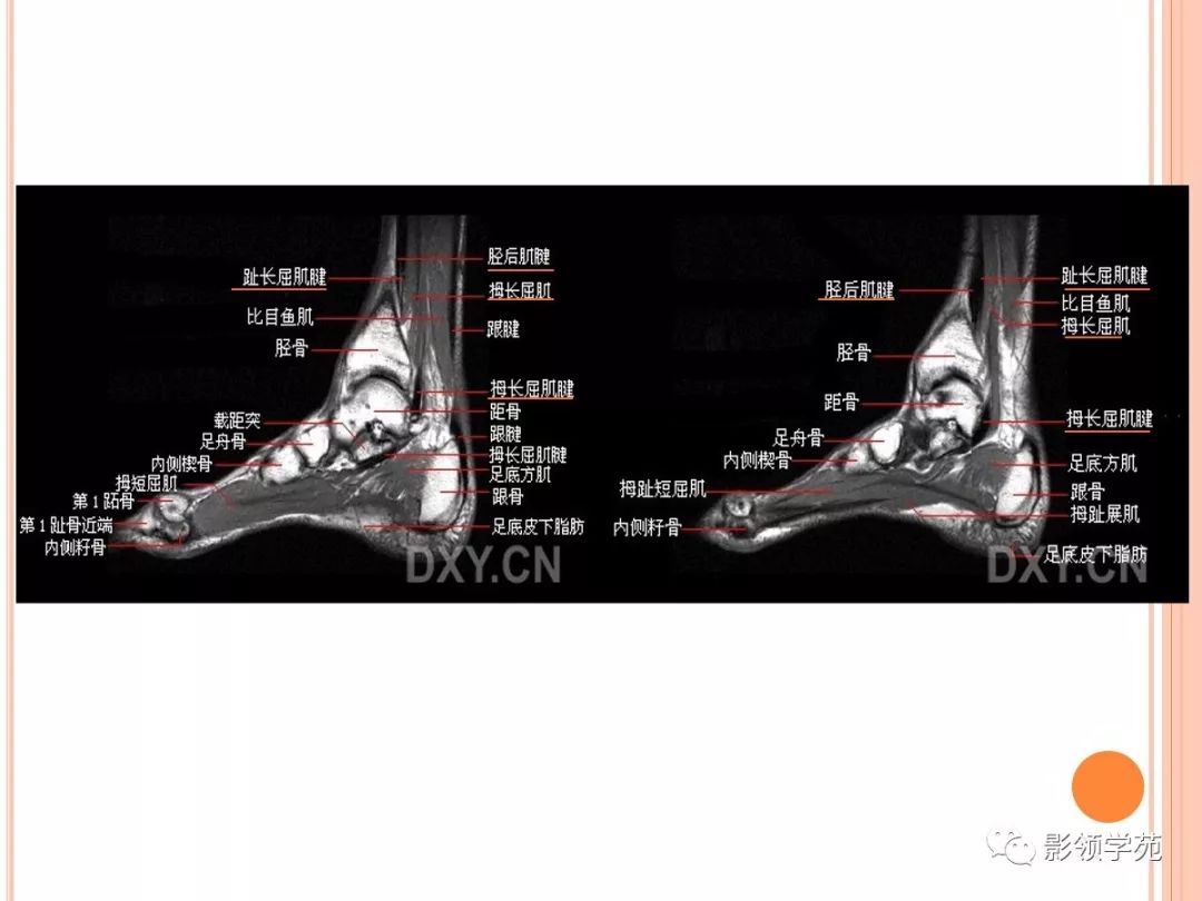 踝關節mri解剖和常見損傷類型