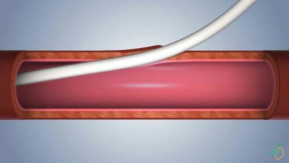 动画演示股动脉穿刺置管