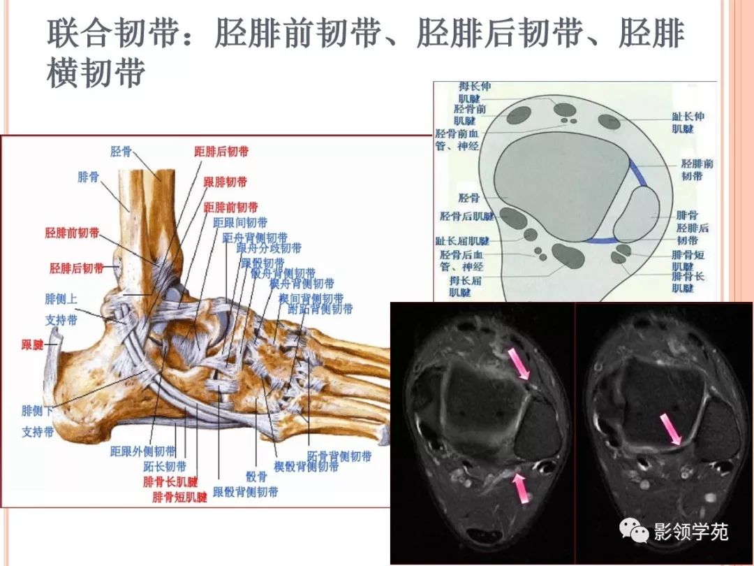 踝关节外侧韧带急性损伤的MRI表现 - 知乎