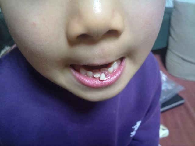 原创7岁男孩长双排牙,需要一颗一颗拔掉,妈妈自责不已:都怪我
