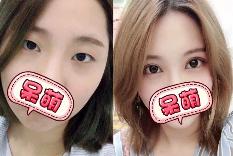 她的双眼皮比天生的还自然!_眼睛