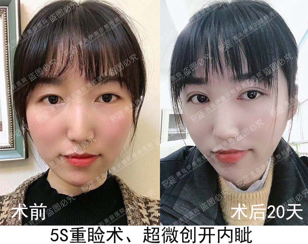 没假期的上班族来体验一下青岛伊美尔的5s重睑术