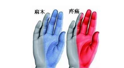 左手臂发麻应警惕的病手麻是什么病的前兆小心藏着这些病